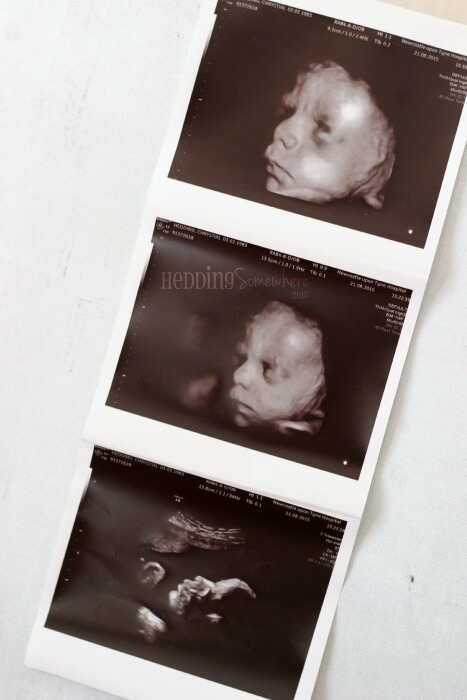 Motherhood Heartachingly Beautiful baby scan